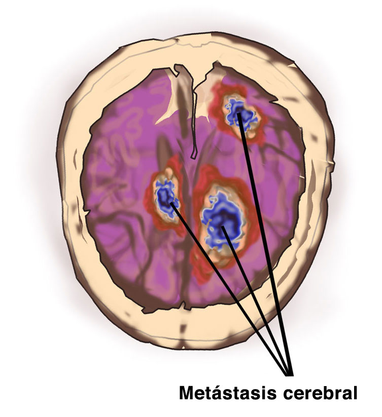 http://mom.ceb.edu.es/wp-content/uploads/2018/07/Metastasis-cerebral.jpg