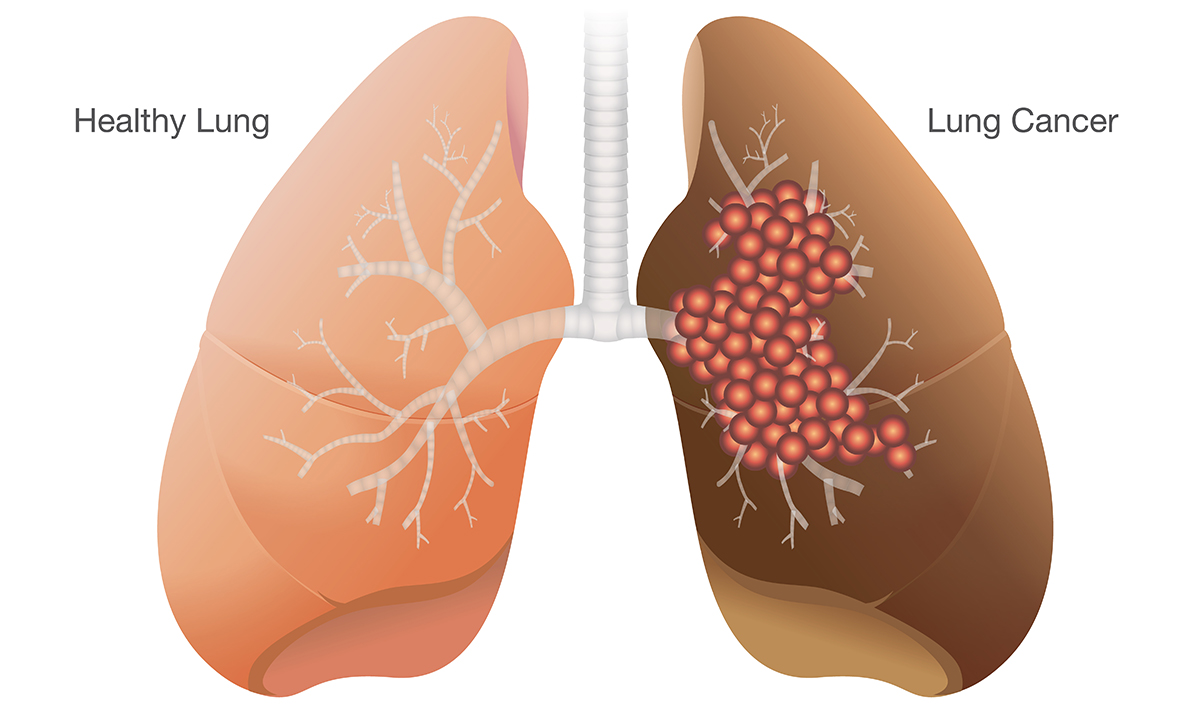 lung-cancer